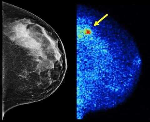 كاشف جديد لأورام الثدي أكثر دقة 3 مرات من الماموجرام