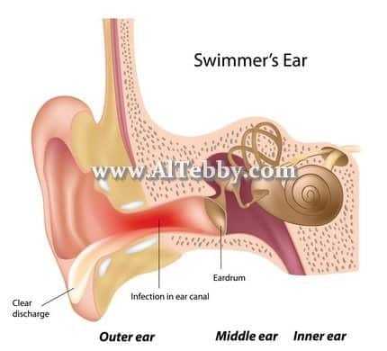 دواء drug التهاب الأذن الخارجية Otitis Externa