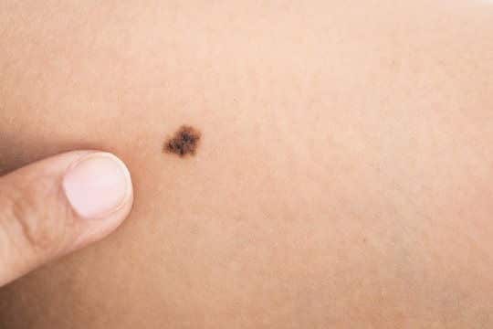 كثرة الشامات بجسمك تعني زيادة احتمال اصابتك بسرطان الجلد