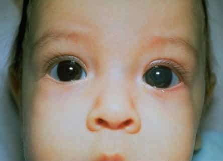 الجلوكوما الخلقية - جلوكوما مرحلة الطفولة Congenital Glaucoma