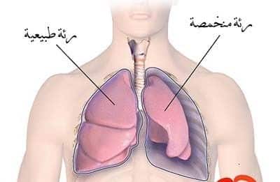 استرواح الصدر Pneumothorax