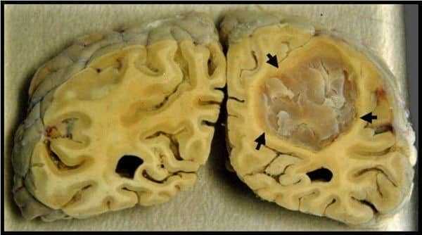 جزء من النسيج الدماغي المحتشي (المتموت) - السكتة الدماغية Brain Stroke