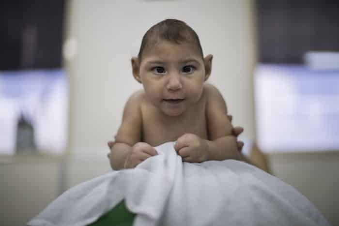 دراسة أمريكية فيروس زيكا يسبب نوبات صرع عند الرضع