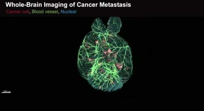 بالفيديو..تقنية جديدة لتصوير انتشار الأورام في الجسم
