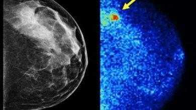 كاشف جديد لأورام الثدي أكثر دقة 3 مرات من الماموجرام