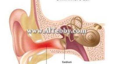 التهاب الأذن الخارجية Otitis Externa