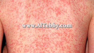 حمو النيل Sweat Rash