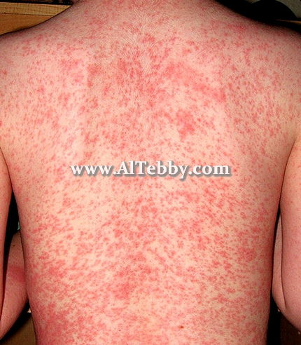 حمو النيل Sweat Rash [دواء drug]