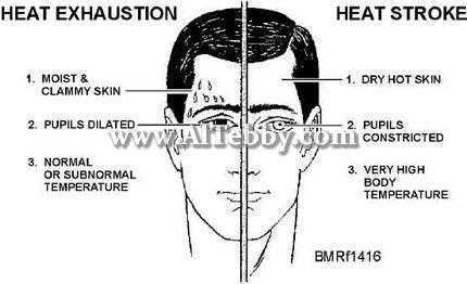 الاجهاد الحراري وضربة الشمس1 [دواء drug]