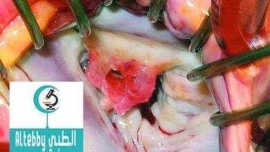 دراسة: لعلاج ارتجاع الصمام الميترالي العنيف استبدال الصمام افضل من اصلاحه
