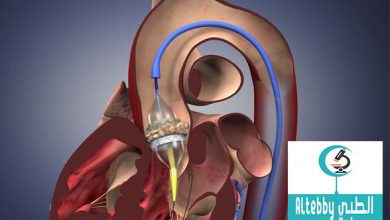 استبدال صمام القلب آمن لكبار السن بواسطة القسطرة القلبية