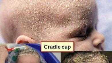 قشرة الرأس في حديثي الولادة Cradle cap