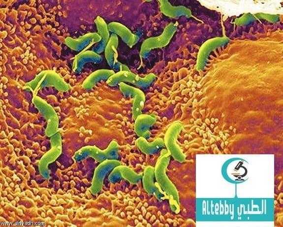 دراسة عدوى مهبلية شائعة تمنع الانجاب دراسة عدوى مهبلية شائعة تمنع الانجاب