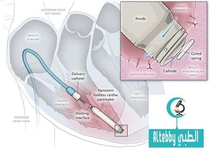منظم ضربات القلب لاسلكي ولا يحتاج لجراحه منظم ضربات القلب لاسلكي ولا يحتاج لجراحه