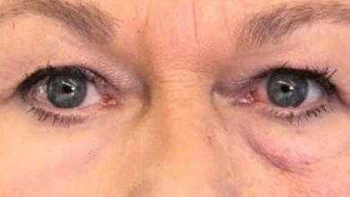 تطوير "طبقة جلد ثانية" تحارب التجاعيد