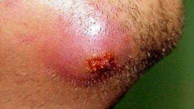 داء الدمامل Carbunculosis