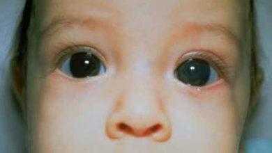 الجلوكوما الخلقية - جلوكوما مرحلة الطفولة Infantile Glaucoma