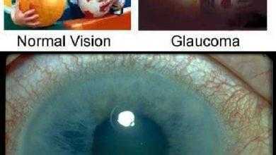 مرضى السكري و الجلوكوما الوعائية Diabetic Glaucoma