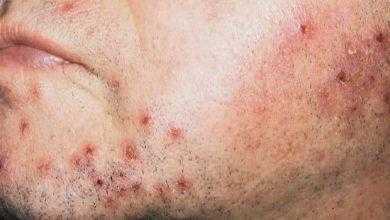 التهاب بصيلة الشعرة Folliculitis