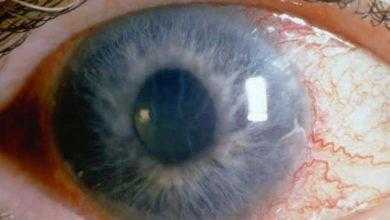 الجلوكوما - المياه الزرقاء Glaucoma - Blue Water