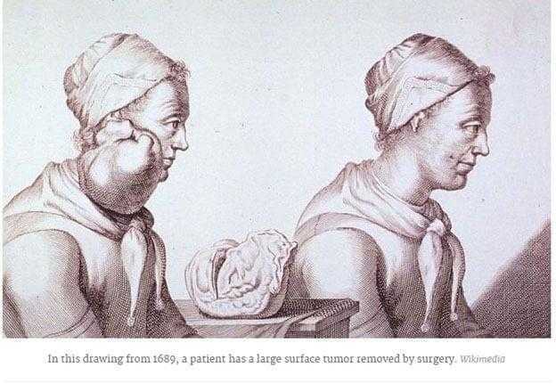تاريخ السرطان History Of Cancer
