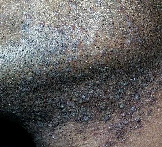التهابات الدقن بعد الحلاقه Pseudofolliculitis Barbae التهابات الدقن بعد الحلاقه Pseudofolliculitis Barbae