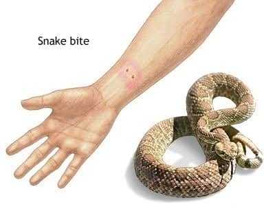 عضة الثعبان Snake Bite3
