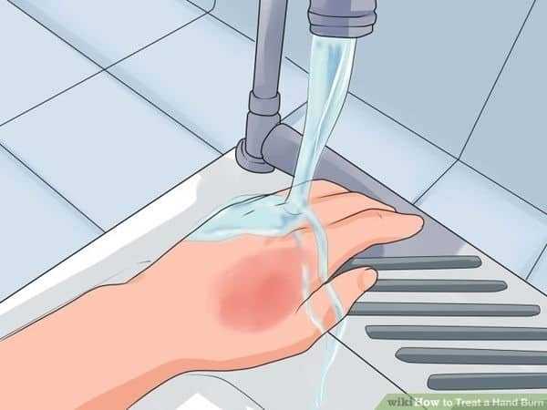 الحروق Burns الحروق Burns