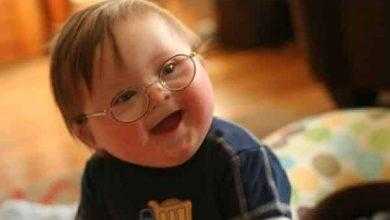 مُتلازِمةُ داون Down Syndrome