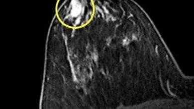 الوَرَم الحُلَیمي القَنَوي Duct papilloma