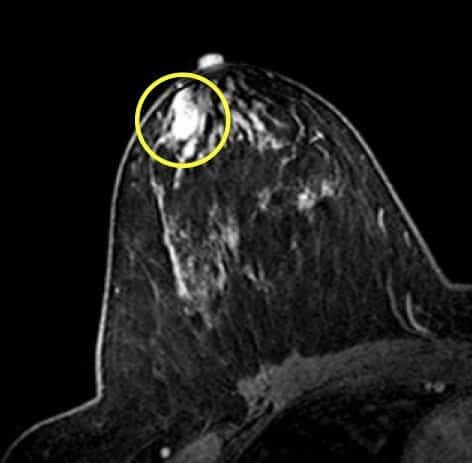 الوَرَم الحُلَیمي القَنَوي Duct papilloma الوَرَم الحُلَیمي القَنَوي Duct papilloma