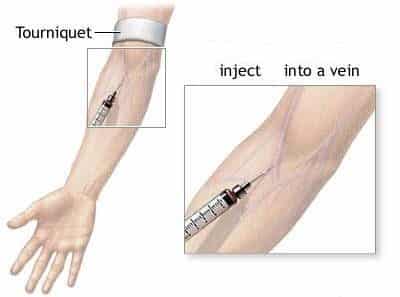 كيفية الحقن الوريدي Intravenous Injection