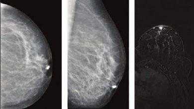أفرازات الحلمة Nipple Discharge