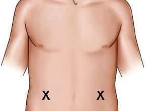 كيفية حقن مضادات التجلط Anticoagulant Injections