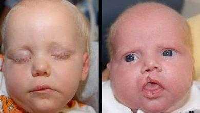 كيفية علاج والوقاية من الحنك والشفة المشقوقة (الشفة الأرنبية) Cleft Palate and Lip