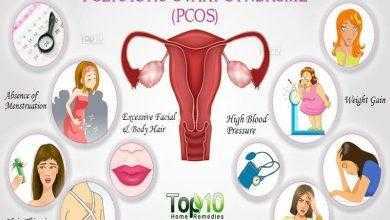 متلازمة تكيس المبيض Polycystic Ovary Syndrome