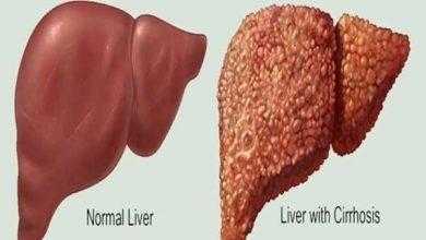 دواء شهير للحساسية والربو يمنع تليف الكبد في التهاب الأوعية الصفراوية