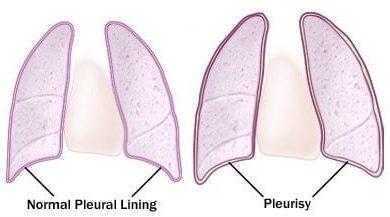 التهاب الغشاء البلوري الجاف Dry Pleurisy