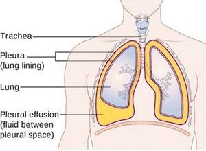 مرض بورنولم Bornholm disease