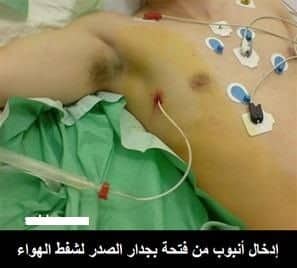 استرواح الصدر Pneumothorax 2 استرواح الصدر Pneumothorax 2