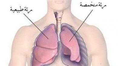 استرواح الصدر Pneumothorax