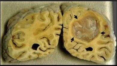 السكتة الدماغية Brain Stroke