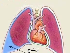 الارتشاح البلوري Pleural Effusion