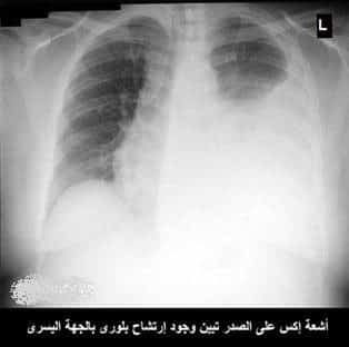 الارتشاح البلوري Pleural Effusion2 الارتشاح البلوري Pleural Effusion2