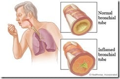300px-Bronchitis 300px-Bronchitis