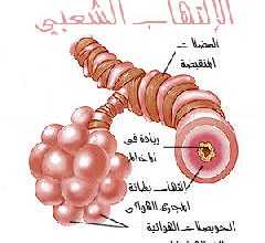 الالتهاب الشعبى الحاد Acute bronchitis