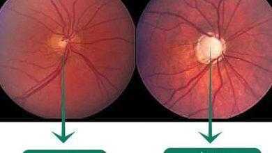 اختبار للعين "يرصد المياه الزرقاء" قبل 10 سنوات من تشخيص الإصابة