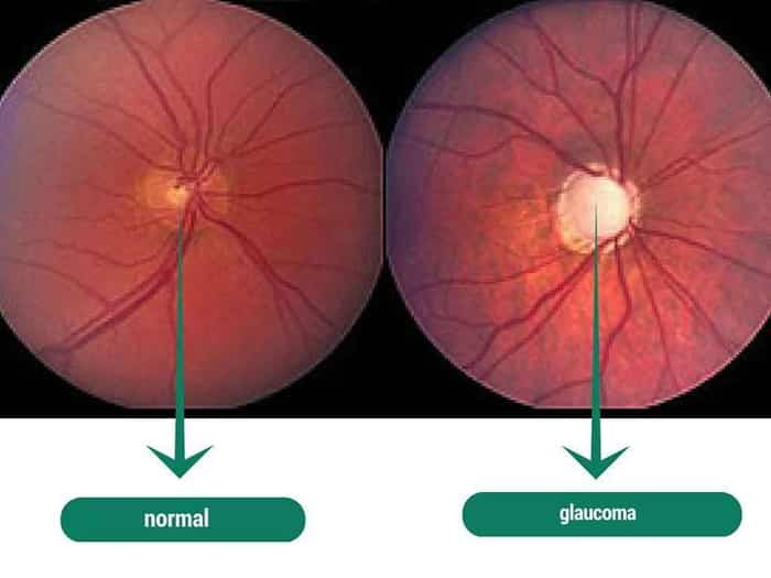 اختبار للعين يرصد المياه الزرقاء قبل 10 سنوات من تشخيص الإصابة اختبار للعين يرصد المياه الزرقاء قبل 10 سنوات من تشخيص الإصابة