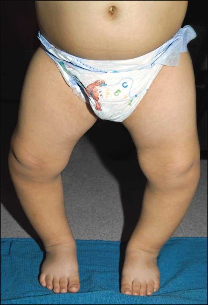 اكتشاف اضطراب عضلي نادر جديد! اكتشاف اضطراب عضلي نادر جديد!