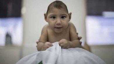 دراسة أمريكية: فيروس زيكا يسبب نوبات صرع عند الرضع